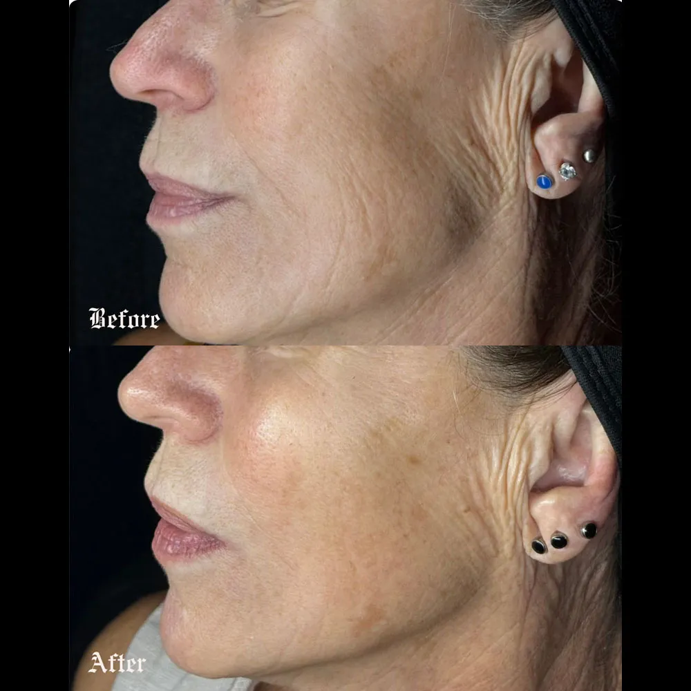 Procell Microchanneling